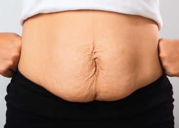 Loose Skin After Weight Loss Surgery