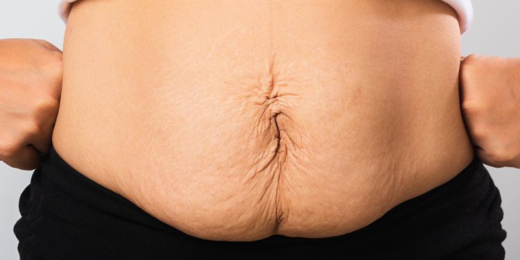 Loose Skin After Weight Loss Surgery