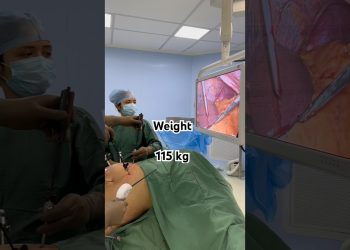 Fastest Weight Loss I Obesity Surgery I Fat Removal Operation I India I Gujarat