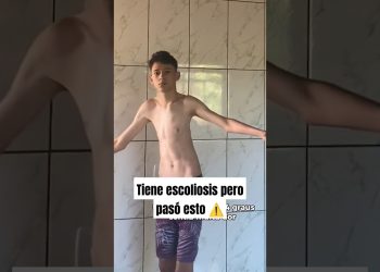 Tenía escoliosis pero hizo esto #gym #escoliosis #fitness #bodybuilding