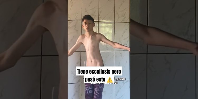 Tenía escoliosis pero hizo esto #gym #escoliosis #fitness #bodybuilding