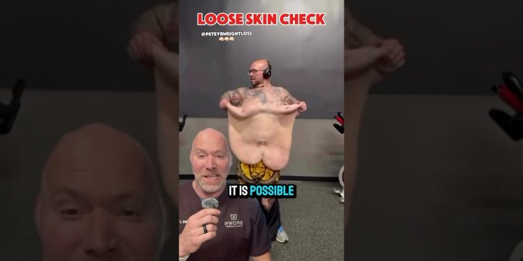 Loose Skin After Massive Weight Loss