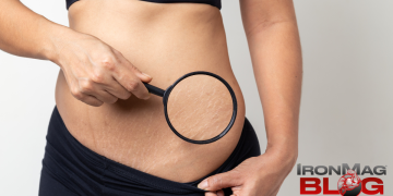 Why Do People Get Stretch Marks — And Can They Go Away? – IronMag Bodybuilding & Fitness Blog