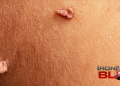 Are Skin Tags a Sign of High Insulin Levels? – IronMag Bodybuilding & Fitness Blog