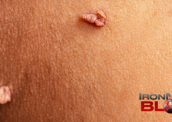 Are Skin Tags a Sign of High Insulin Levels? – IronMag Bodybuilding & Fitness Blog