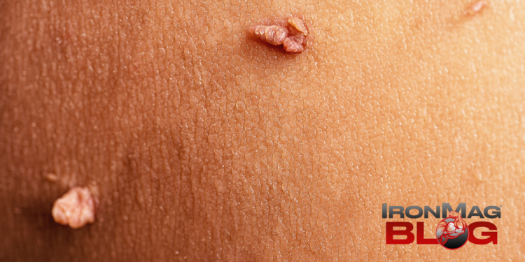 Are Skin Tags a Sign of High Insulin Levels? – IronMag Bodybuilding & Fitness Blog