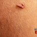 Are Skin Tags a Sign of High Insulin Levels? – IronMag Bodybuilding & Fitness Blog